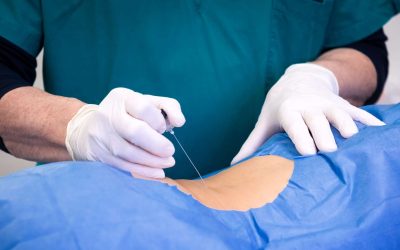 Injections de PRP (Plasma Riche en Plaquettes)
